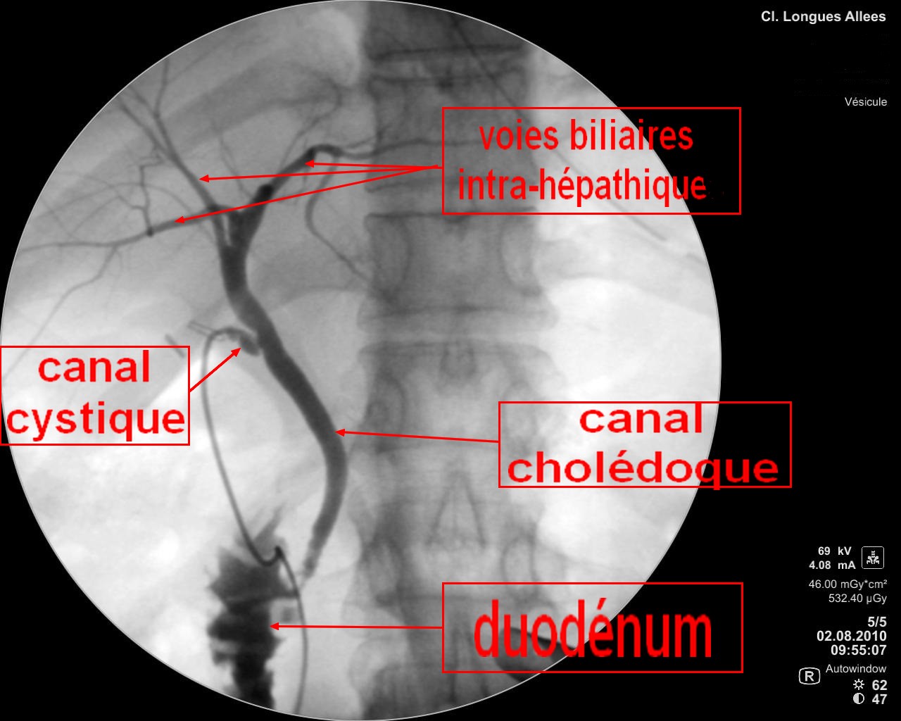 Chirurgie de la vésicule biliaire et des voies biliaires, Orléans, Région c Chorus chirurgical Chirurgie de la vésicule biliaire et des voies biliaires, Orléans, Région c Chorus chirurgical